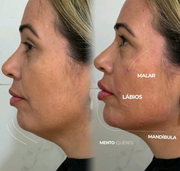 Harmonização Facial - Antes e Depois