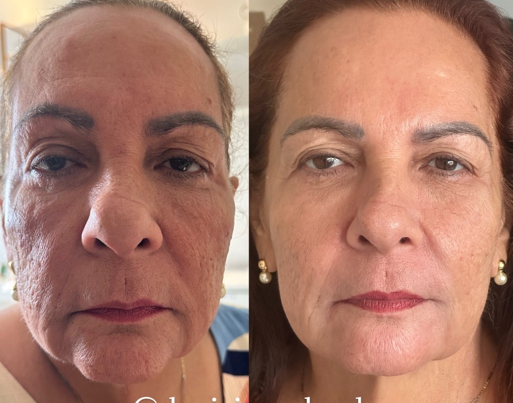 Rejuvenescimento Facial Antes e Depois
