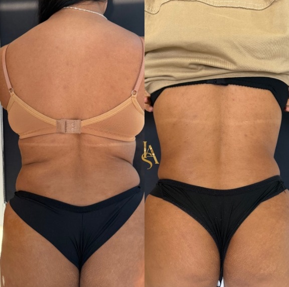 Tratamentos Corporais Antes e Depois